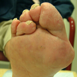 Avondeten Matron Overleving Pijnlijke voeten – Diabetische Voeten